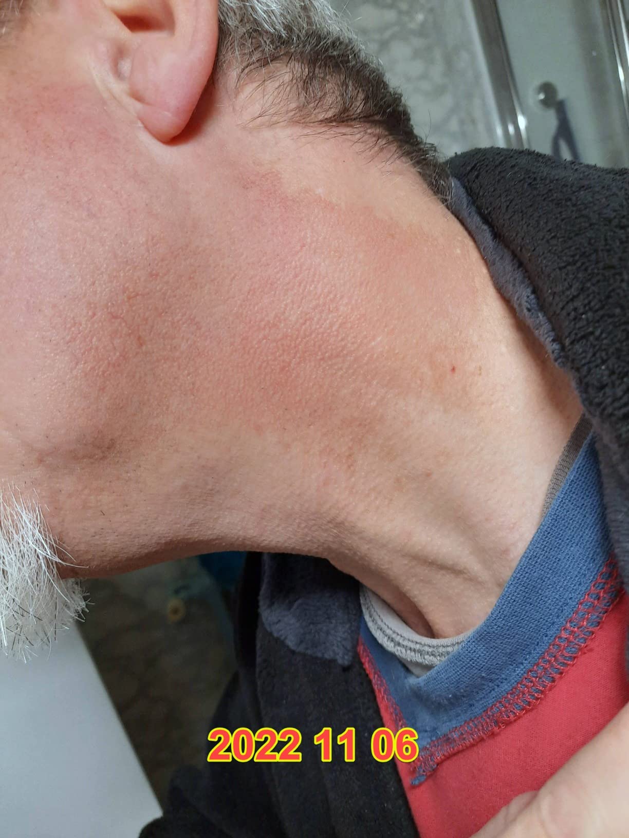 Un soulagement pour ma couperose