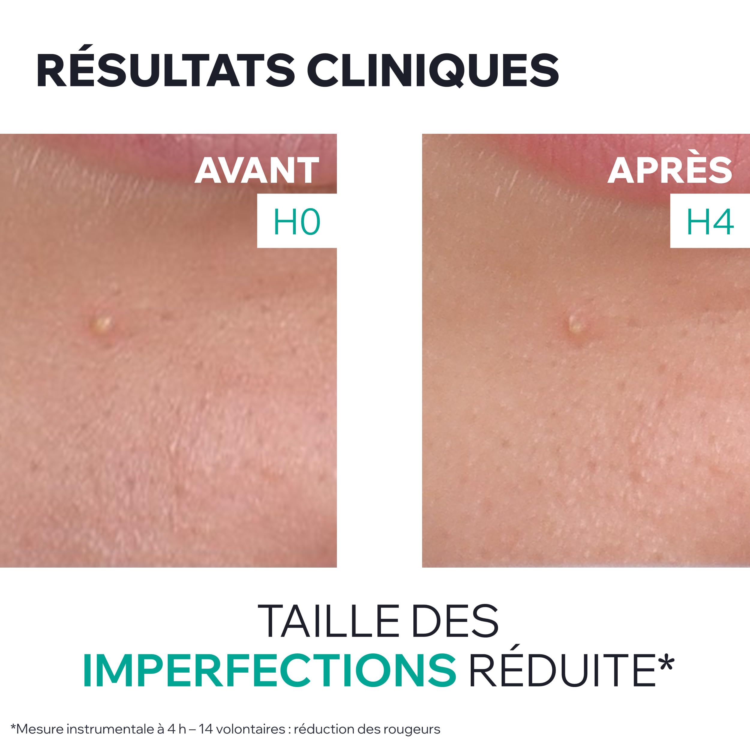 uriage-hyseac-gel-sos-ass-chant-5-7-aha-bha-soin-localis-anti-imperfections-effe image 6