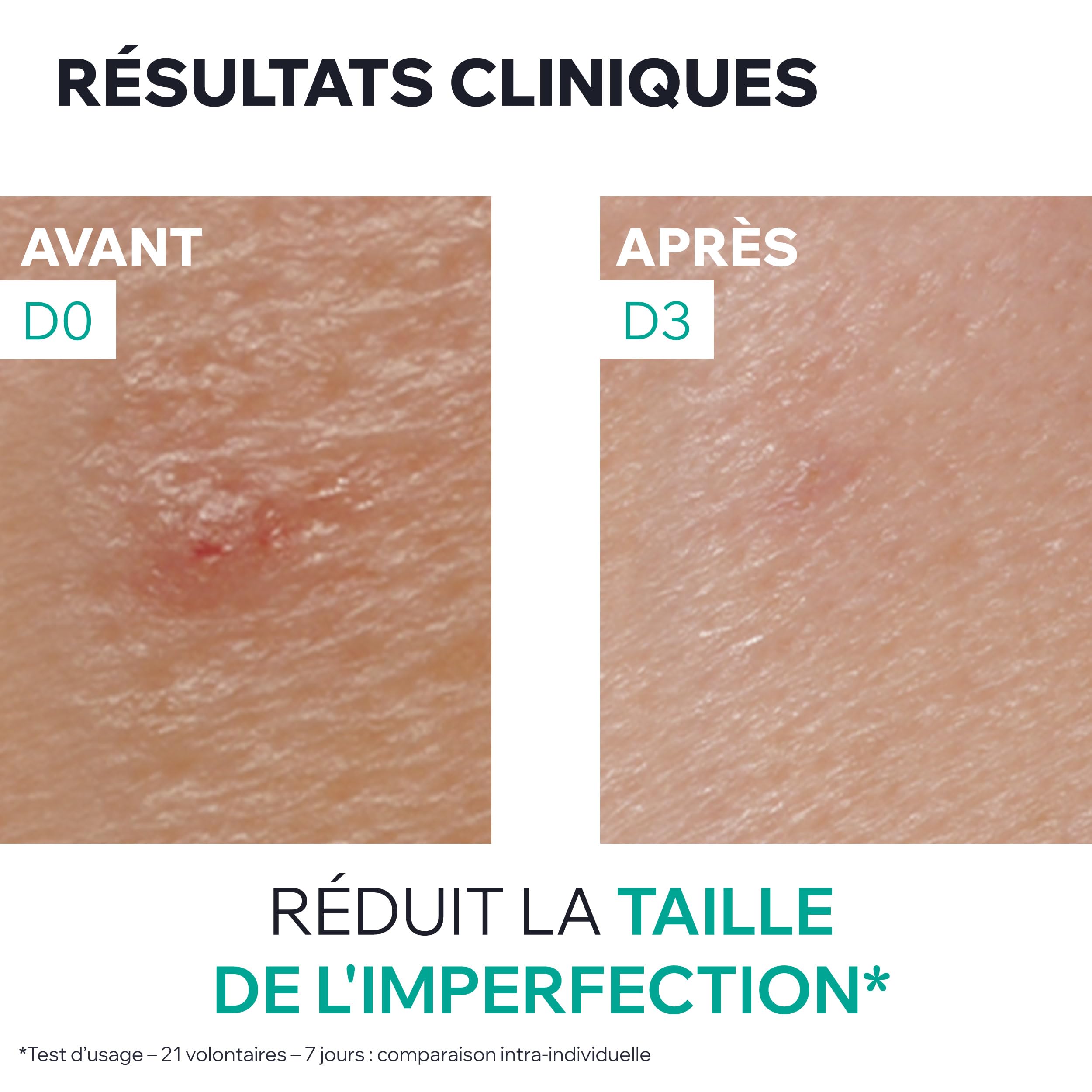 uriage-hys-ac-p-te-sos-15-g-argile-verte-zinc-arbre-th-soin-local-anti-imperfect image 6