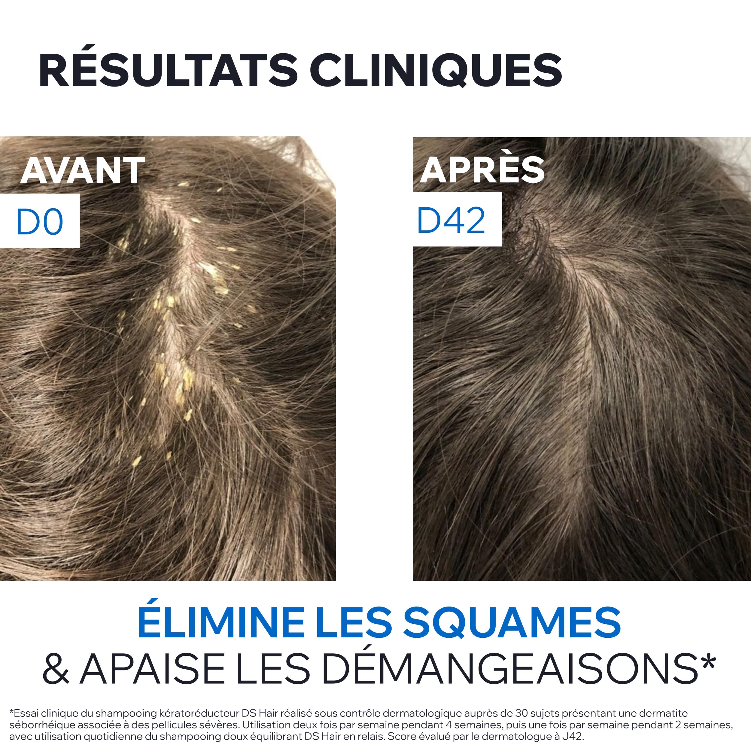 uriage-ds-hair-shampooing-traitant-k-rator-ducteur-acide-lactique-1-8-pellicules image 6
